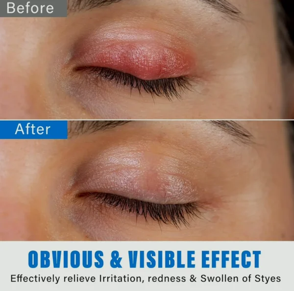 Styê Vision Treatment Drops for Fast Relief